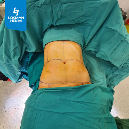 Abdominoplastie Photos avant & après