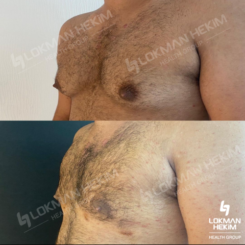 Pubic liposuction Before / After photo