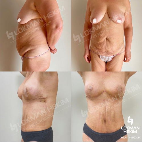 Thigh lift Before / After photo