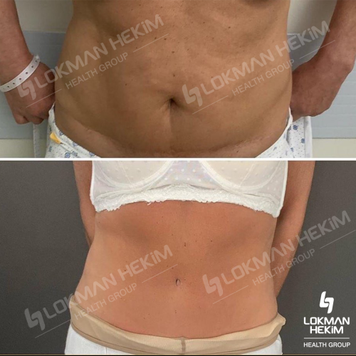 Arm lift Before / After photo