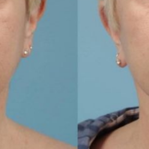 Платизмопластика (подтяжка шеи) Фотографии до и после