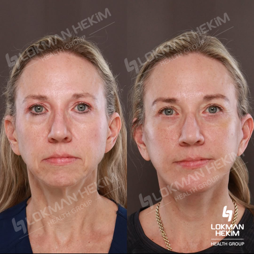 Jawline contouring Photo avant/après