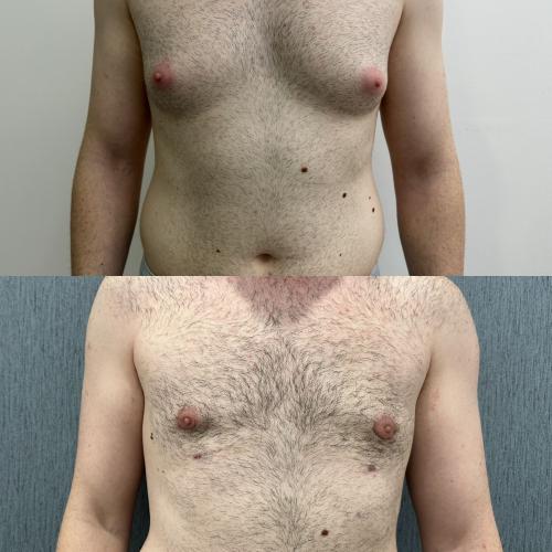 Tratamiento de ginecomastia (con liposucción) Foto antes/después