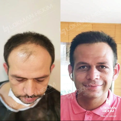 Trasplante de barba Foto antes/después