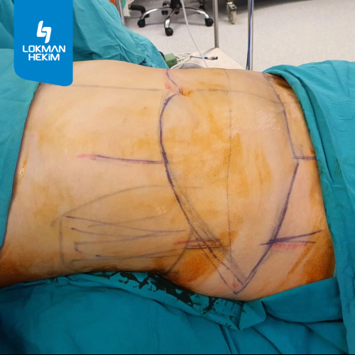 Liposucción Foto antes/después