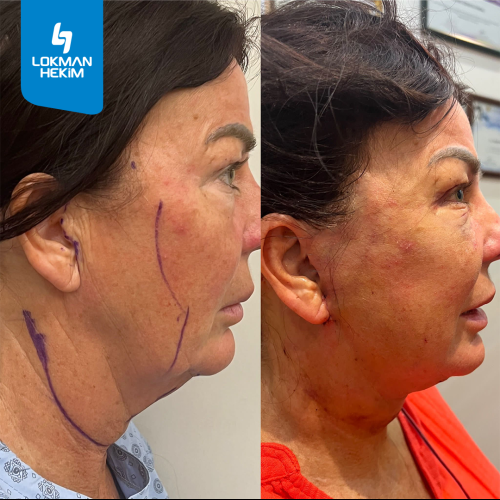 Thread lift Before / After photo