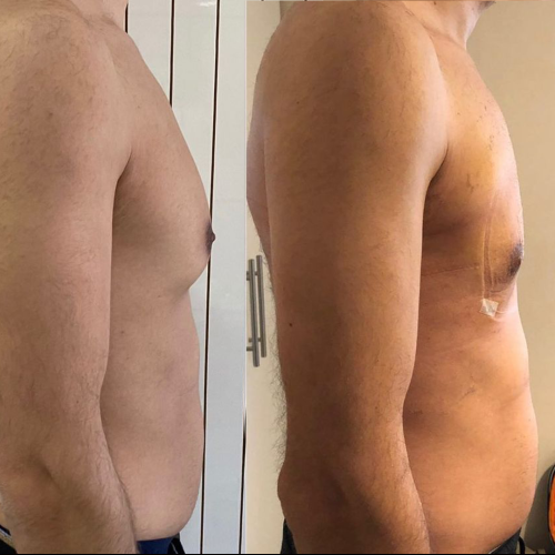 Traitement de la Gynécomastie (avec liposuccion) Photos avant & après