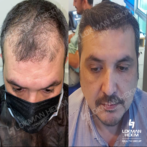 Trasplante de barba Foto antes/después
