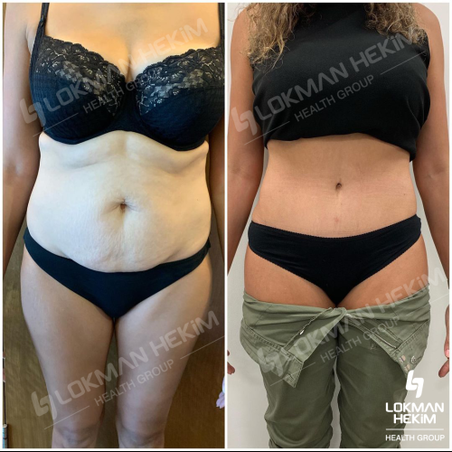 Thigh lift Before / After photo