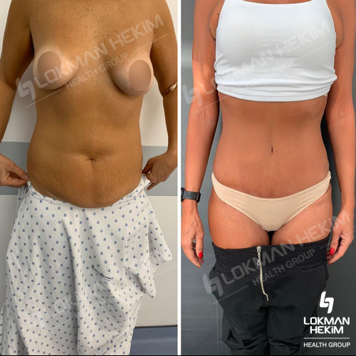 Thigh lift Before / After photo