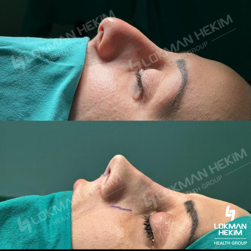 Septoplasty Before / After photo