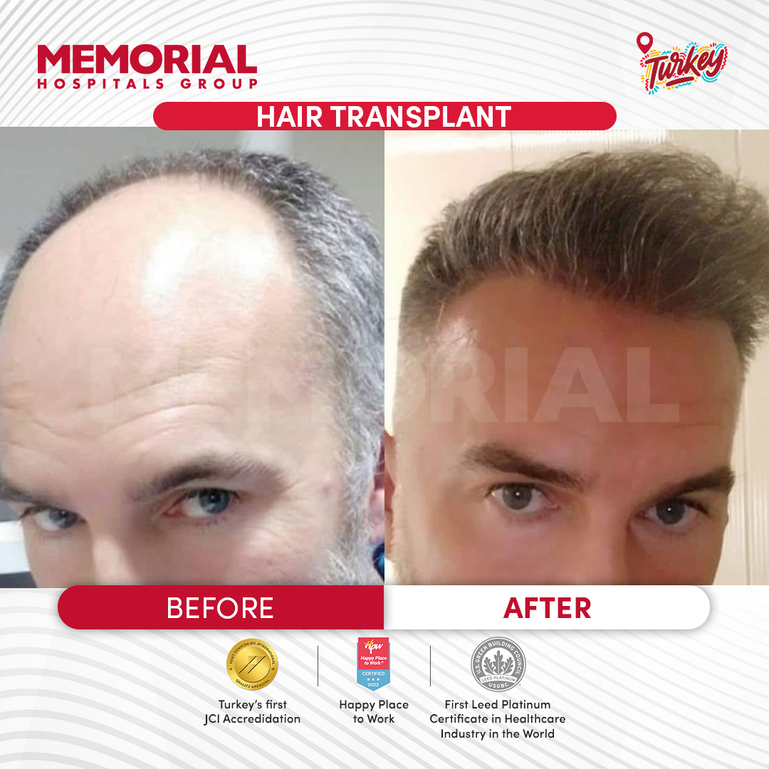 PRP for Hair Loss