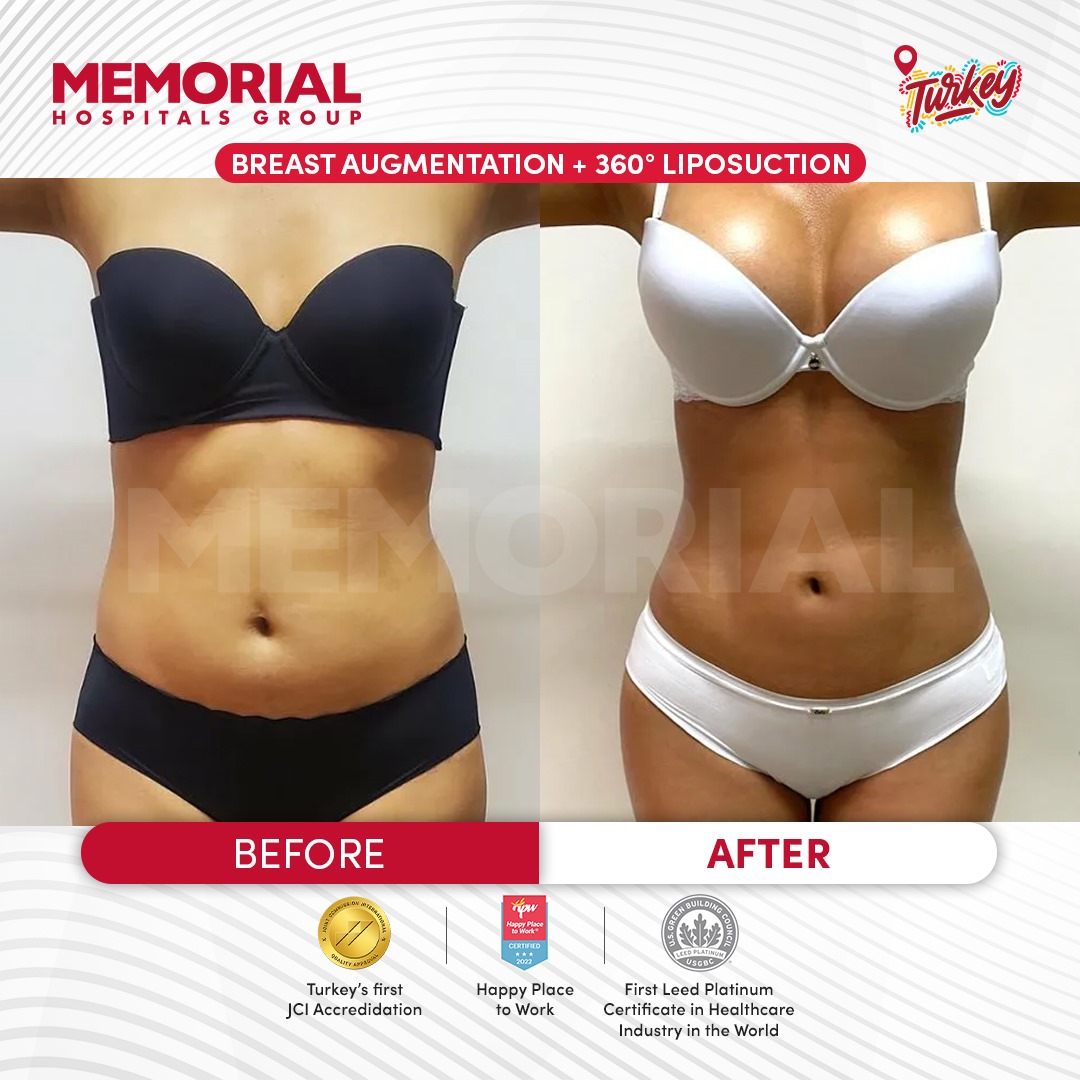 Lifting de los senos