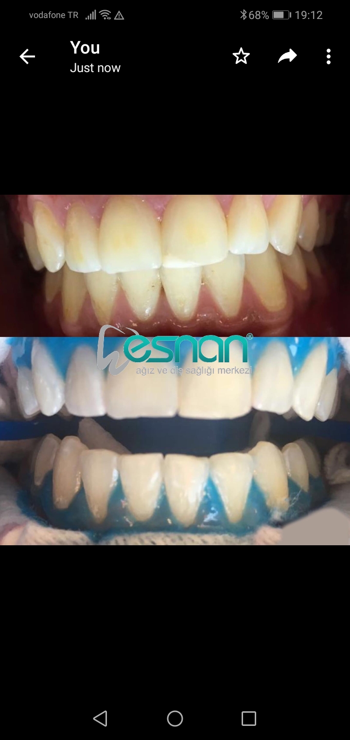 Blanchiment Dentaire