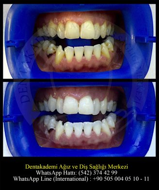 Blanchiment Dentaire