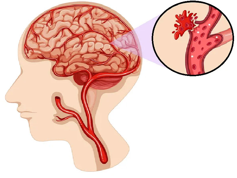 Кровоизлияние в мозг (нарушения мозгового кровообращения): Причины и лечение