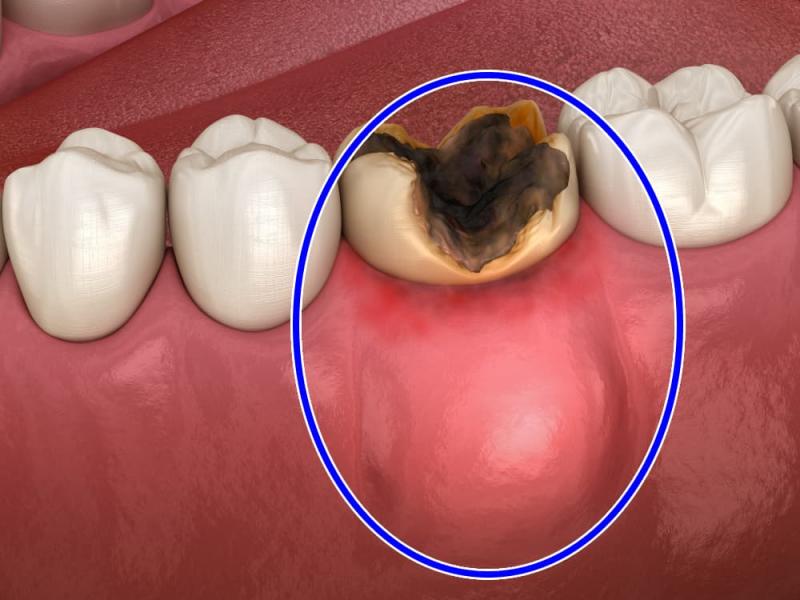  Абсцесс зуба: как он лечиться?