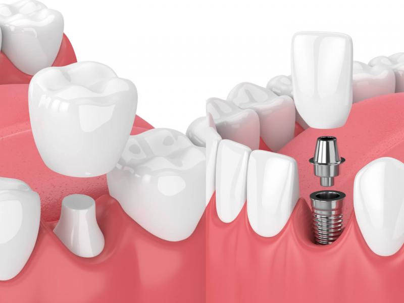 Потерянный зуб: мостовидный протез или имплантат?