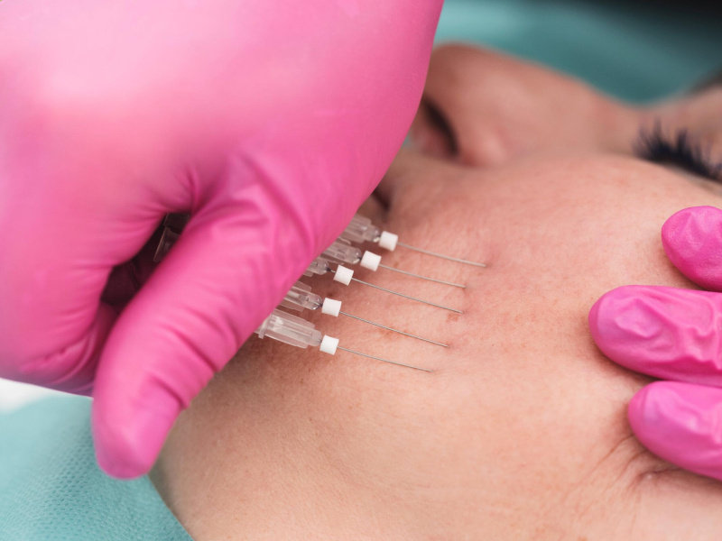 Thread lift: How it works, who it's for, and what to expect 