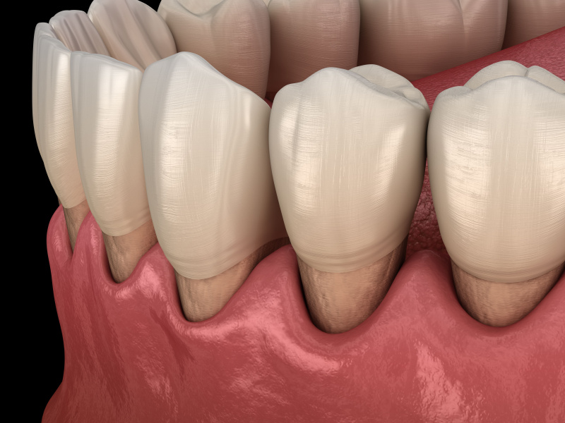 Récession gingivale : pourquoi vos gencives se rétractent et comment y remédier ?