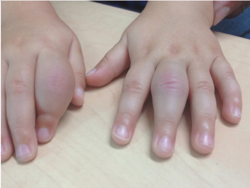 Juvenile idiopathic arthritis: A complete guide for parents