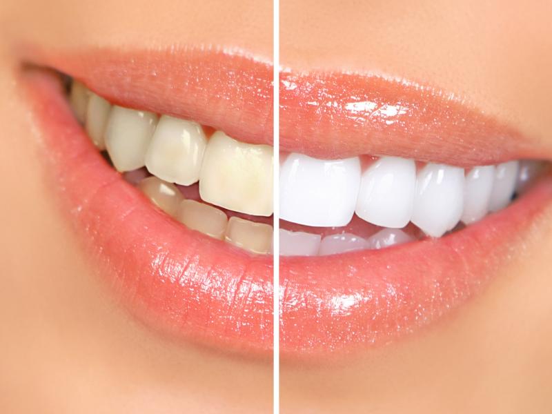 Brighten up your smile with dental whitening in Turkey