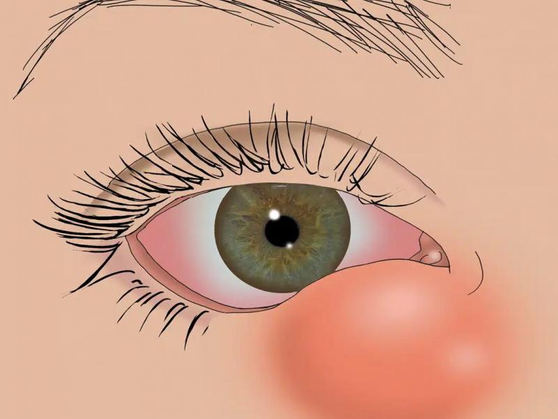 Say Goodbye to Watery Eyes: Effective Treatments for Dacryocystitis
