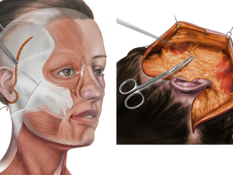 Deep Plane Facelift vs SMAS: What the 2026 evidence actually shows