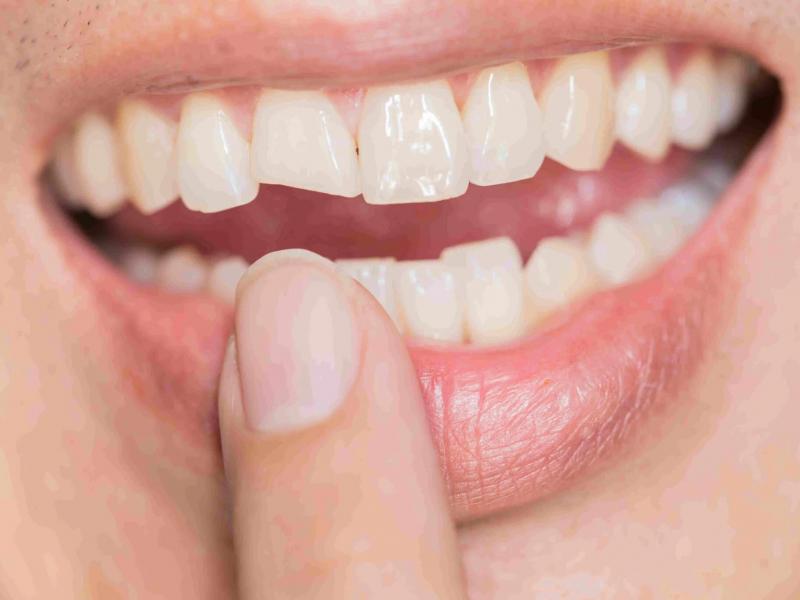 الأسنان المكسورة أو المتكسرة: كيف يتم إصلاحها؟