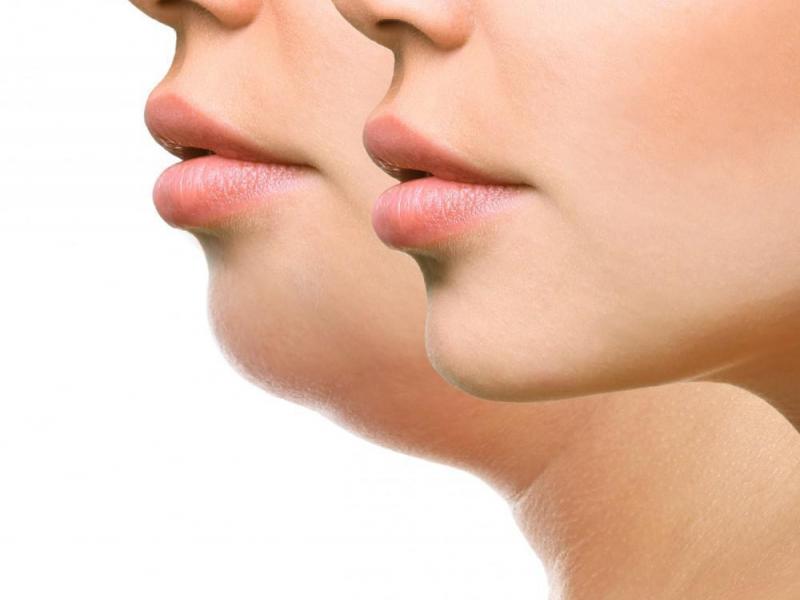 Double chin SOS: Proven remedies for a more defined jawline