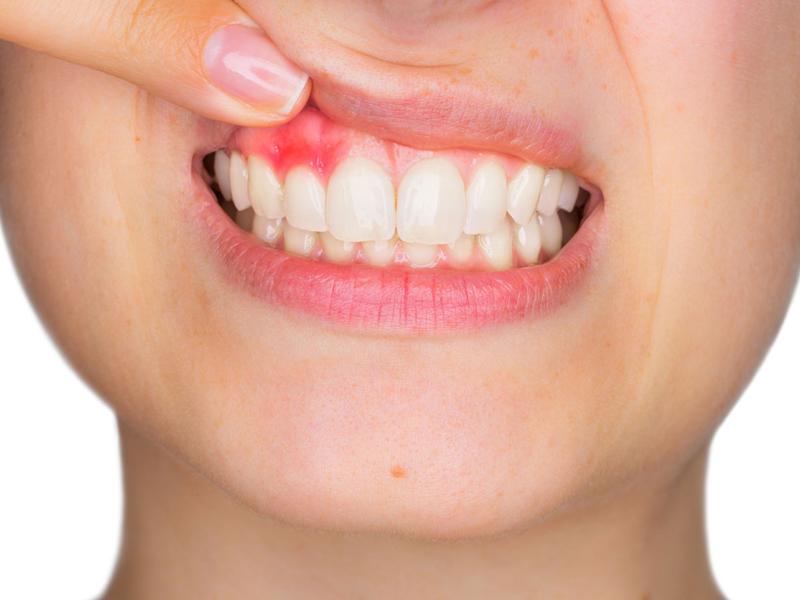 Fístula dental: causas, síntomas y opciones de tratamiento