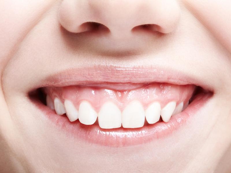 Gummy smiles: your options for correction
