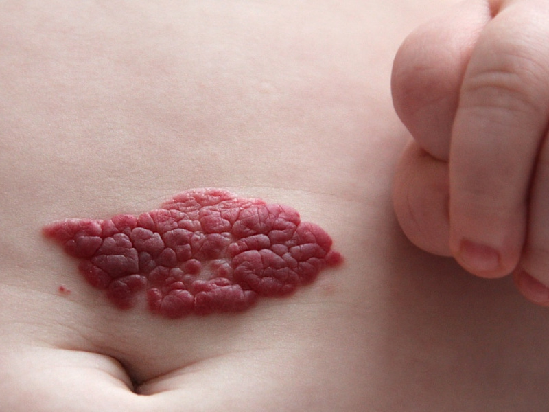 Hemangiomas y sistema cardiovascular: ¿hay una conexión que debemos conocer?