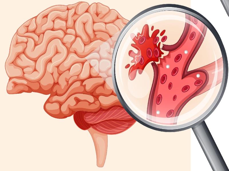 Cerebral hemorrhage: Causes, warning signs & treatment