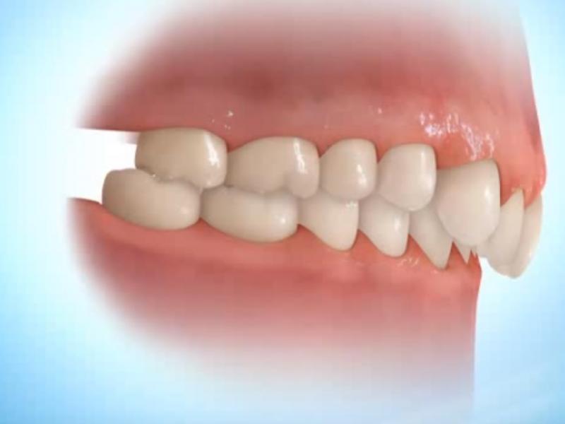 Malocclusion dentaire : la tétine pourrait-elle en être la cause ?