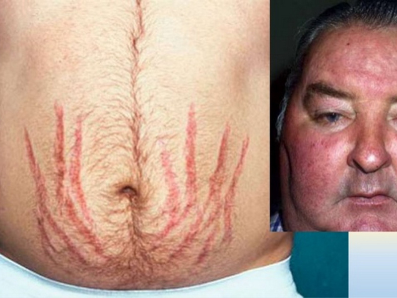 Síndrome de Cushing: ¿cómo afecta al corazón y qué riesgos cardiovasculares implica?