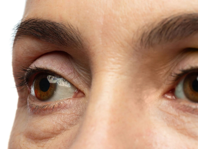 Malar bags: understanding their origin and finding the right treatment