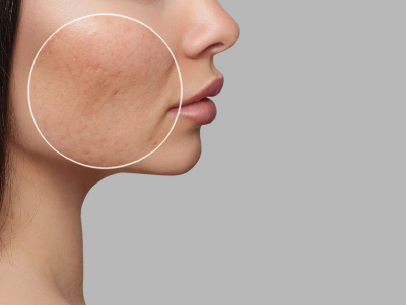 Dilated pores: Causes, what really works & how to reduce them