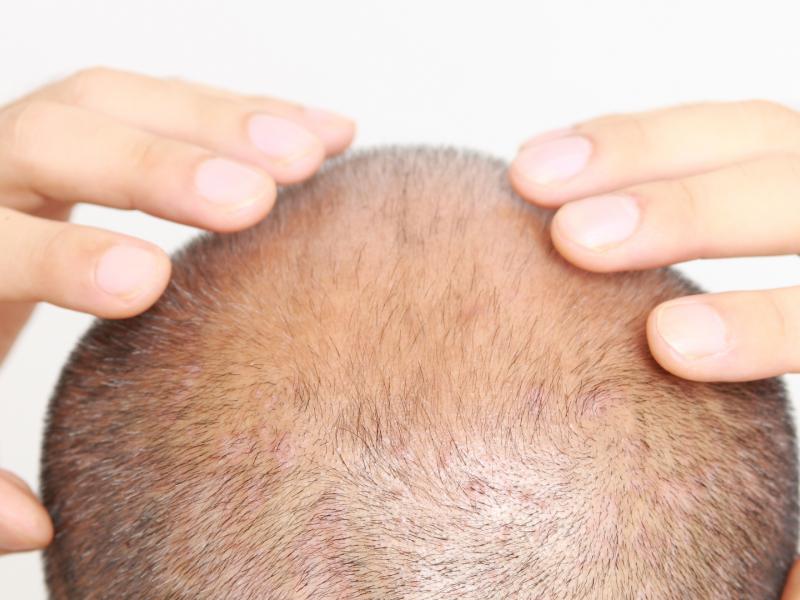 Effet Shock Loss : Mes cheveux tombent-ils après une greffe ?