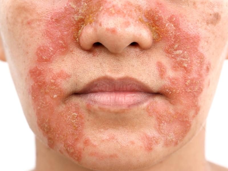  Dermatitis or Eczema: the different types and how to distinguish them?
