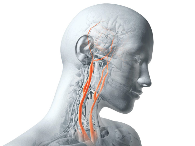 Hemorrhagic vs ischemic stroke: Key differences, symptoms & treatment - Medical guide 