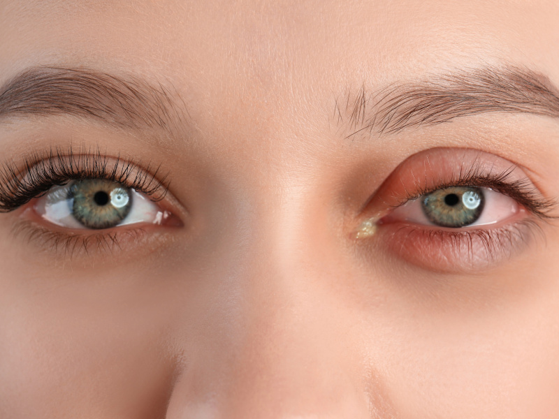 Swollen eyelids: Causes, remedies, and surgical solutions for a refreshed look