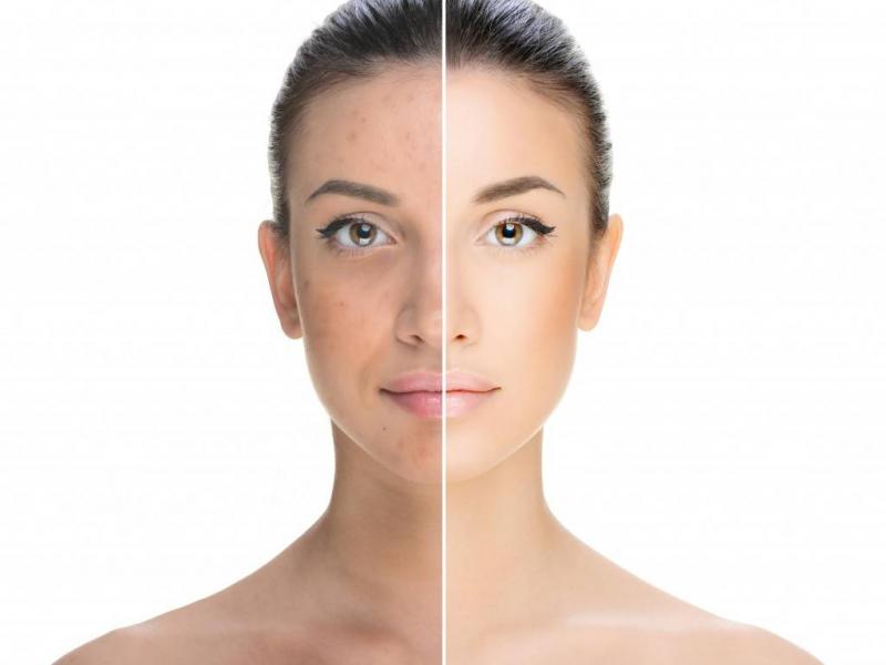 Medical and aesthetic treatments to remove dark spots on the face