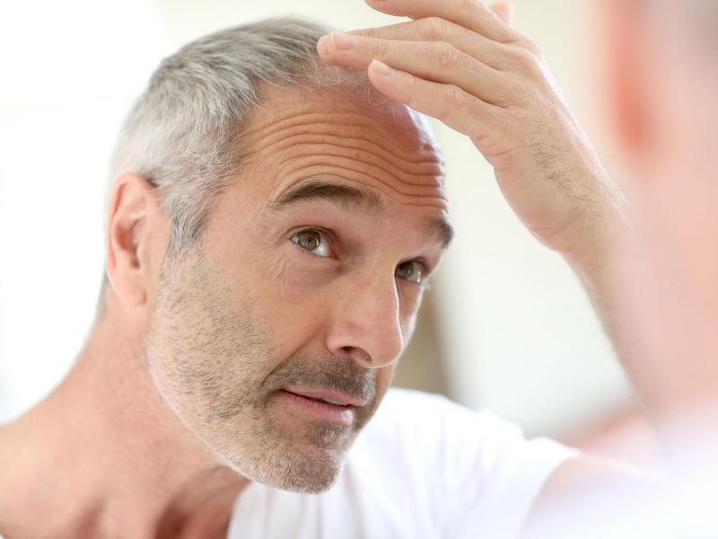 Say goodbye to baldness with hair transplant surgery in Turkey