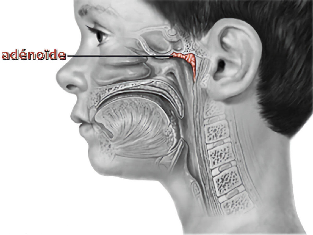 Etiological factors in adenoid hypertrophy 2026