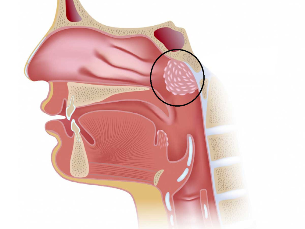 Adenoid removal in Turkey at a reasonable price 2026