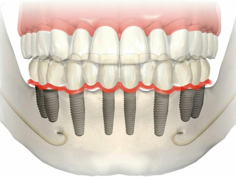 ¿Cuáles son las ventajas de los implantes TODOS EN 8? 2026 ¿Cuáles son las ventajas de los implantes TODOS EN 8? 2026