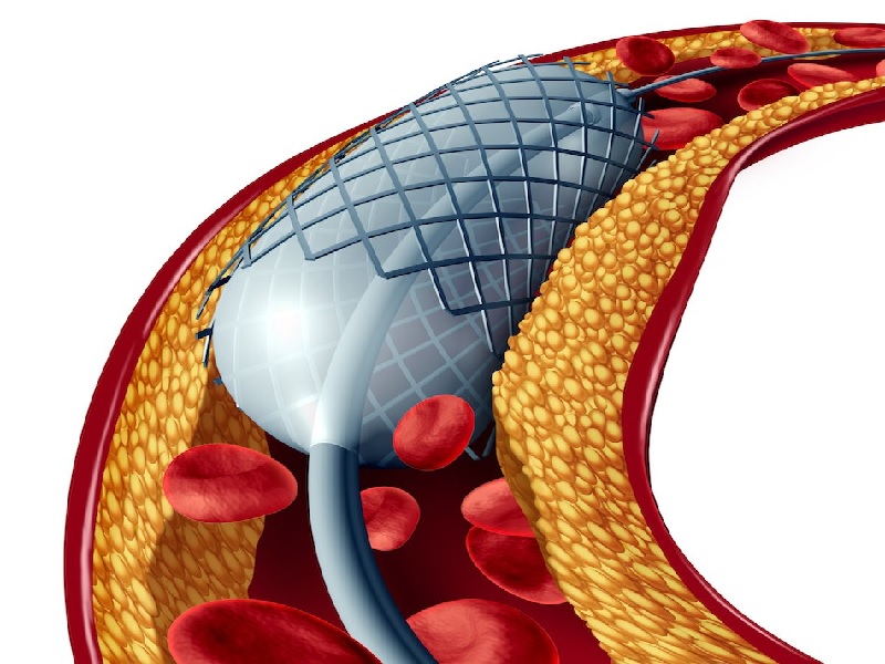 ¿Cuándo se realiza una angioplastia coronaria? 2026