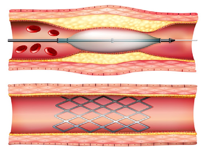 Etapas de la angioplastia coronaria en Turquía 2026