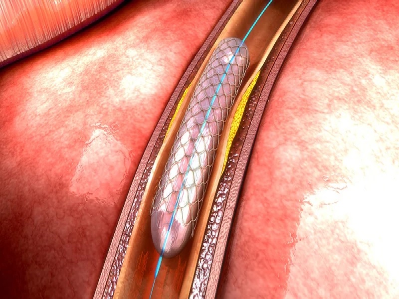 ¿Qué es la angioplastia coronaria? 2026